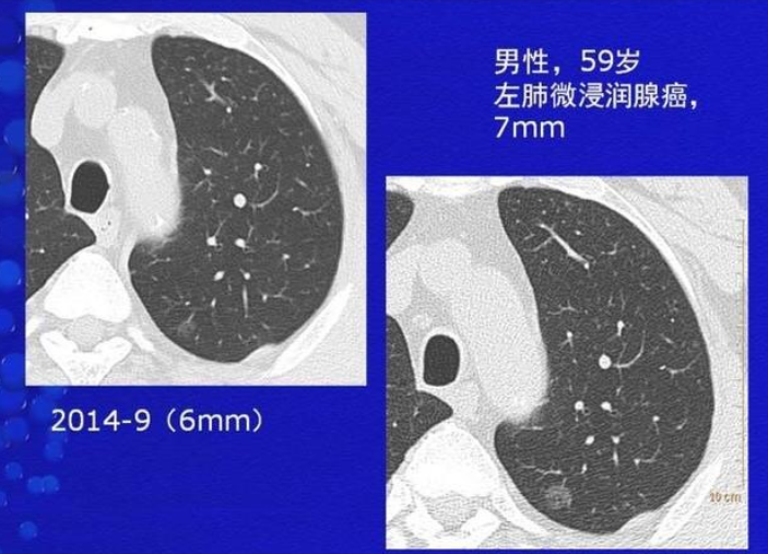 肺部结节需要治疗吗