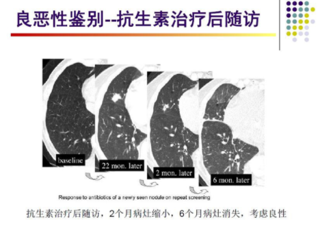 肺结节吃什么药能散结