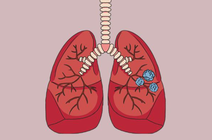 肺结节吃什么药能散结