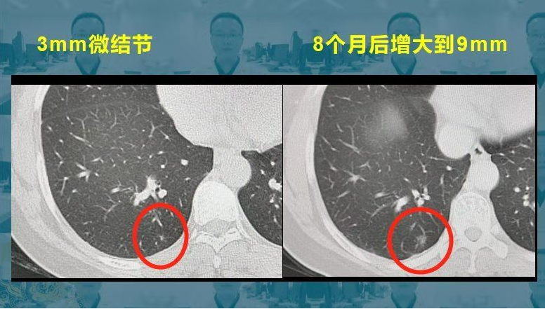 磨玻璃结节