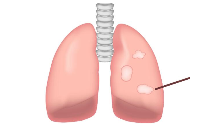 肺部结节最怕三个征兆