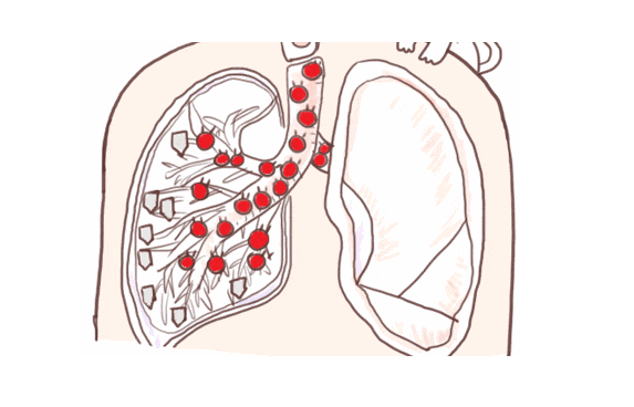 肺部结节形成原因