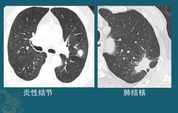 肺部结节