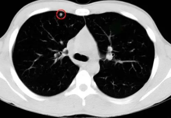 肺有结节怎么办