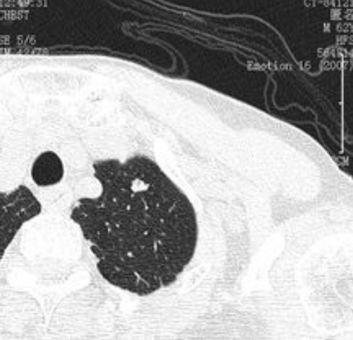左肺上叶小结节