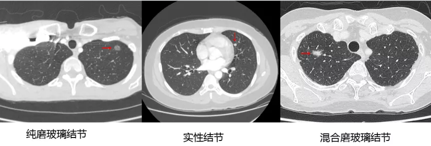 肺部结节