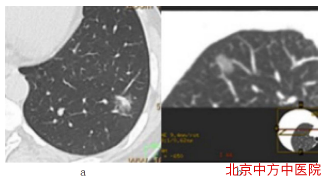 磨玻璃结节