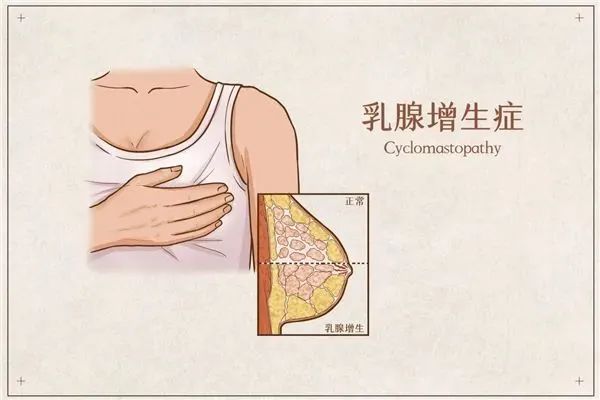 乳腺增生