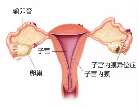 子宫内膜异位征