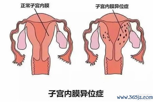 子宫内膜异位症