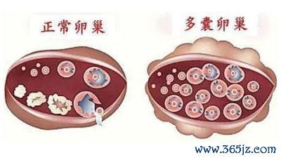 多囊卵巢